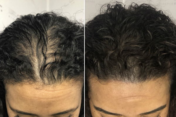 alopecia-androgenetica-femminile-napoli
