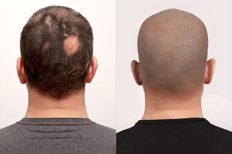 alopecia-areata-prima-dopo-napoli